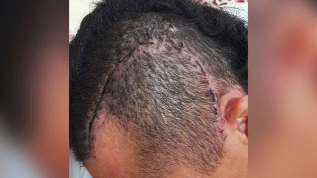 Agredida a pauladas, transexual recebe alta, mas espera cirurgia no maxilar - Campo Grande News