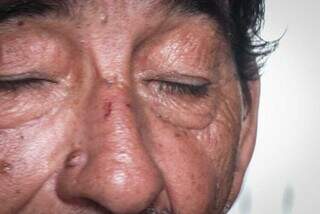 Machucado no nariz do idoso mostra onde assaltante deu coronhada (Foto: Henrique Kawaminami)