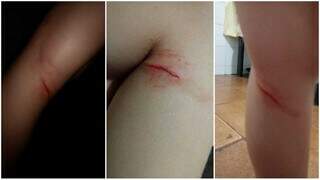 Pai enviou fotos das agressões no corpo de uma das crianças