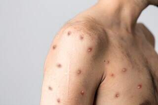 Um dos sintomas da varíola são feridas na pele. (Foto: Reprodução)