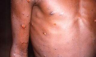 Lesões na pele de quem sofre de varíola. (Foto: Doença provoca lesões na pele. (Foto: CDC-Brian W.J. Mahy/Agência Brasil/ReproduçãoSecretaria de Estado de Saúde MS)