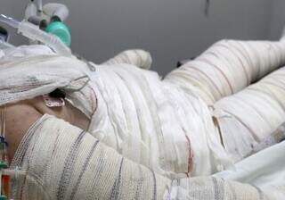 Criança hospitalizada após sofrer acidente doméstico que causou queimaduras. (Foto: Divulgação/Santa Casa)