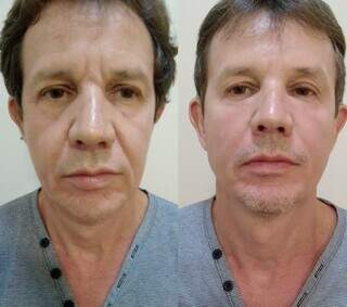 Antes e depois da harmonização facial