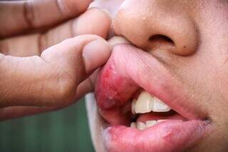 Adolescente mpstra ferimento nos lábios após agressão. (Foto: Henrique Kawaminami)