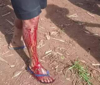 Indígena ferido na perna após confronto; segundo defensor, alguns deles, não procuraram hospital ao saber que seriam presos (Foto: Aty Guasu)