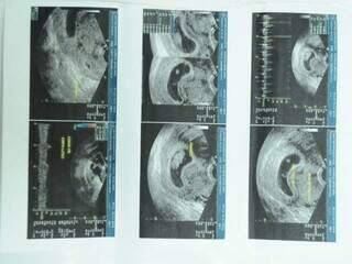 Exame de gravidez mostra feto na barriga de uma mãe, em Campo Grande. (Foto: Arquivo/Campo Grande News)