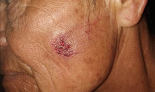 Ferimento no rosto de idoso ferido no ataque. (Foto: Gazeta News)