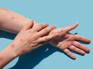 Erupções na pele, um dos sintomas da varíola dos macacos. (Foto/Divulgação)