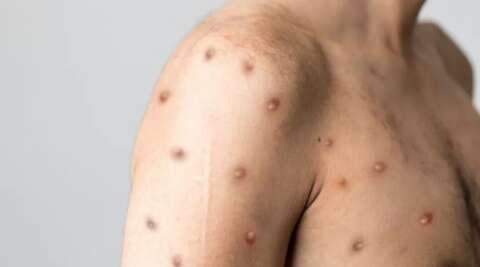 "Não é motivo de alarde", diz secretário sobre 1ª confirmação de varíola