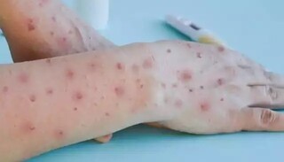Paciente de varíola dos macacos desenvolve erupçõs cutâneas na pele, que podem transmitir doença. (Foto: Reprodução/Pixabay)