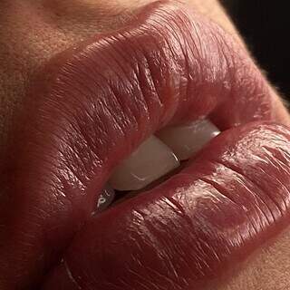 Preenchimento labial é uma das instervenções feitas para harmonização do rosto. (Foto: Divulgação)