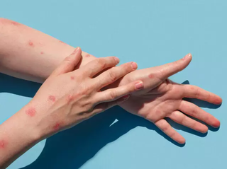 Erupções na pele é um dos sintomas da varíola dos macacos. (Foto/Divulgação)