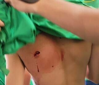 Adolescente mostra ferimento de faca nas costas, desferido por colega. (Foto: Direto das Ruas)