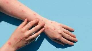 Um dos sintomas da varíola dos macacos são feridas na pele. (Foto: Divulgação) 