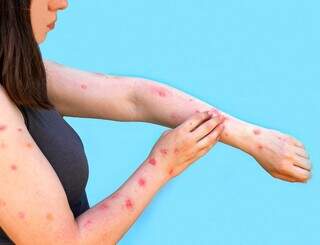 Um dos sintomas da varíola dos macacos são feridas na pele. (Foto: Freepik Premium)