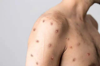 Um dos sintomas da varíola do macaco são as feridas na pele do paciente. (Foto: Reprodução) 