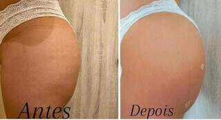 O antes e depois do tratamento mais avançado para o bumbum. (Foto:Divulgação)