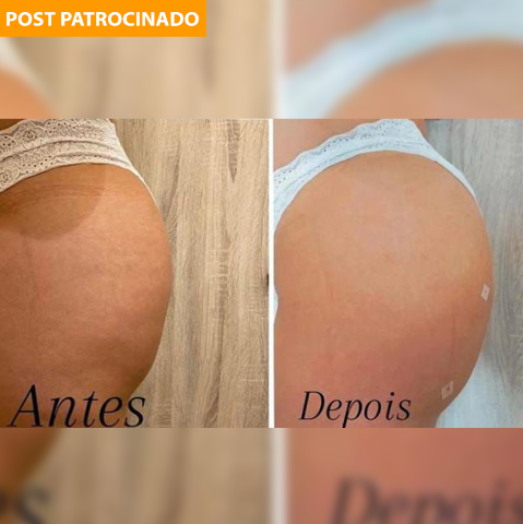 Bumbum empinado e sem celulite é com a Royal Face