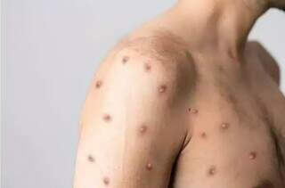 Um dos sintomas da varíola do macaco são as feridas na pele do paciente. (Foto: Reprodução)