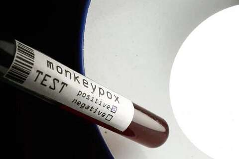 Em 24h, casos de Monkeypox saltam para 42 em MS