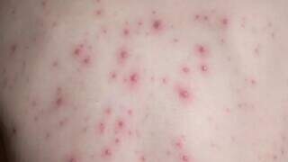 Lesões na pela, causadas pela varíola dos macacos (Foto: Reprodução/Shutterstock)