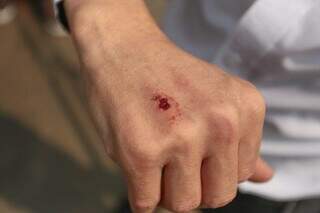 Jairo mostra ferimento na mão (Foto: Marcos Maluf)