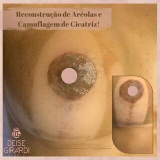 Studio faz reconstrução de aréola gratuita às mulheres que venceram o câncer de mama. (Foto: Divulgação)