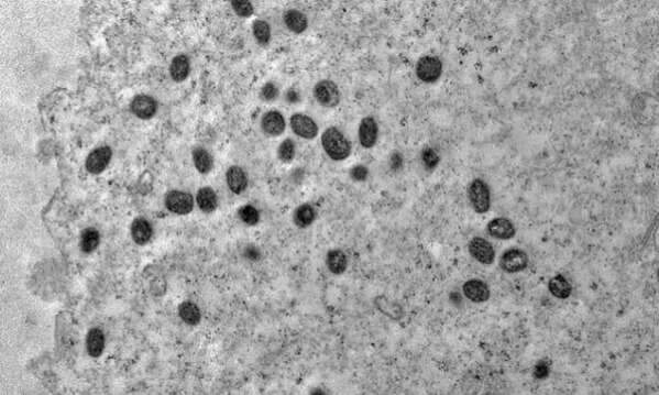 Adolescente de 16 anos est&aacute; entre os seis novos casos de Monkeypox em MS