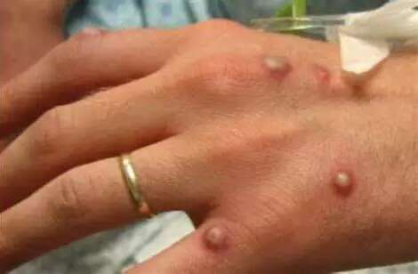 Saúde cadastra laboratórios para diagnóstico de varíola dos macacos