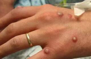 Bolhas são alguns dos sinais de varíola (Foto: Cofen)