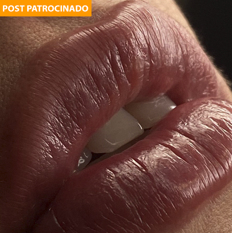 Verão e fim de ano faz procura por harmonização facial aumentar