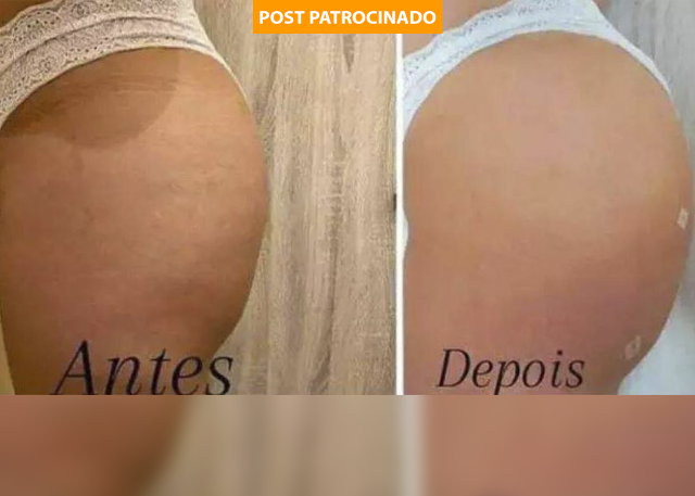 Veja qual o melhor tratamento para preparar o bumbum para o verão