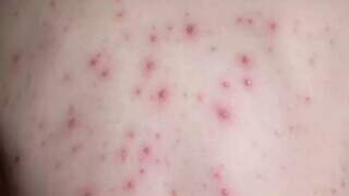 Feridas na pele são alguns dos sintomas da varíola dos macacos (Foto: Reprodução/Shutterstock)