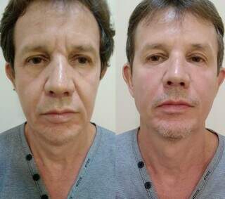 Diga adeus a flacidez e recupere a sustentação facial . (Foto: Arquivo)