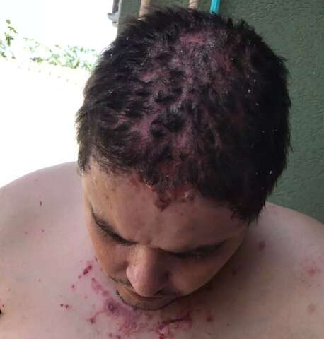 H&aacute; tr&ecirc;s meses motorista sofre com fogo selvagem, doen&ccedil;a autoimune rara