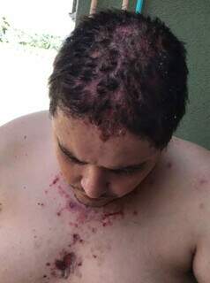  Herickson sofre com uma doença rara que afeta a pele e o couro cabeludo (Foto: Arquivo pessoal)