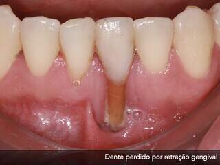Foto mostra que retração gengival pode causar até perda de dente sem o tratamento necessário. (Foto: Divulgação)