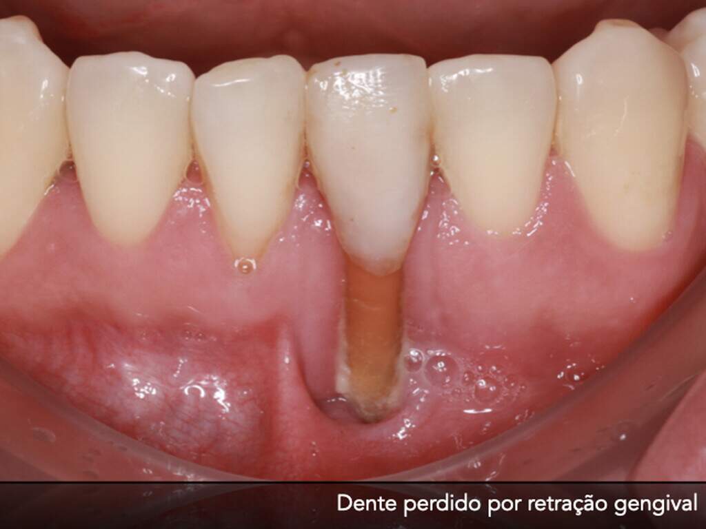 Sensibilidade dentária pode sinalizar algo maior e precisa de ...