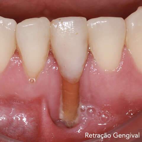 Sensibilidade dentária pode sinalizar algo maior e precisa de tratamento