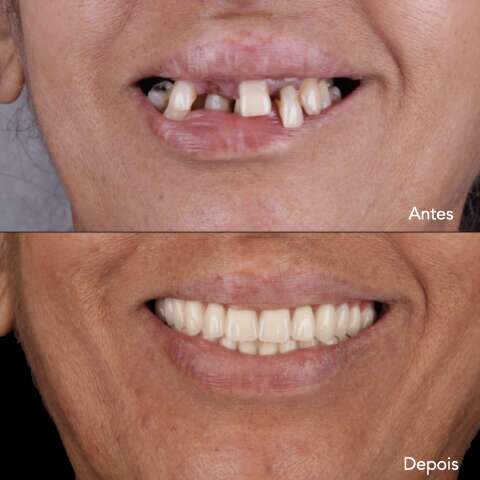 Com implante dentário sem dor você volta a sorrir sem sofrimento