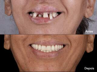 Mais do que mastigar bem, os implantes dentários trazem a vontade de sorrir novamente. (Foto: Divulgação)