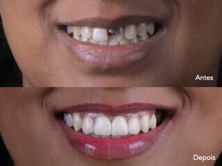 Antes e depois do implante dentário mostra diferença incrível. (Foto: Divulgação)
