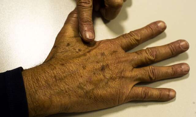 Inca estima que Brasil deve registrar 220 mil casos c&acirc;ncer de pele