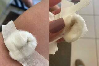 Na primeira foto é o algodão ainda no braço da paciente (Foto:Direto das Ruas)
