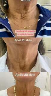 Procedimento para rejuvenescimento tem resultado rápido. (Foto: Divulgação)