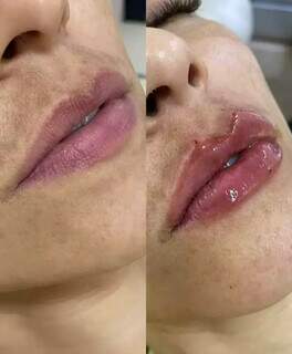 Preenchimento labial é um dos tratamentos bônus de janeiro. (Foto: Divulgação)