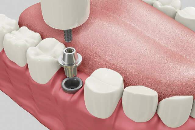 Mitos e verdades sobre implantes dentários