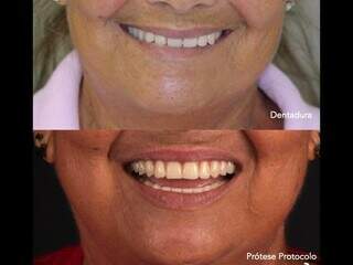 Pacientes relatam uma liberdade maior para sorrir após a mudança. (Foto: Divulgação)