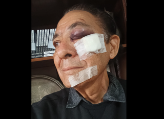Ex-deputado estadual e escritor sofre queda em falha de cal&ccedil;ada e fica ferido 