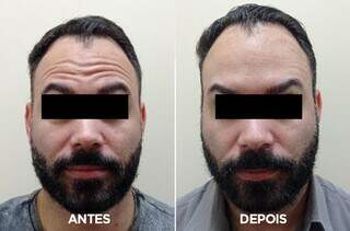 Cliente optou por fazer Botox Power em três regiões do rosto. (Foto: Divulgação)